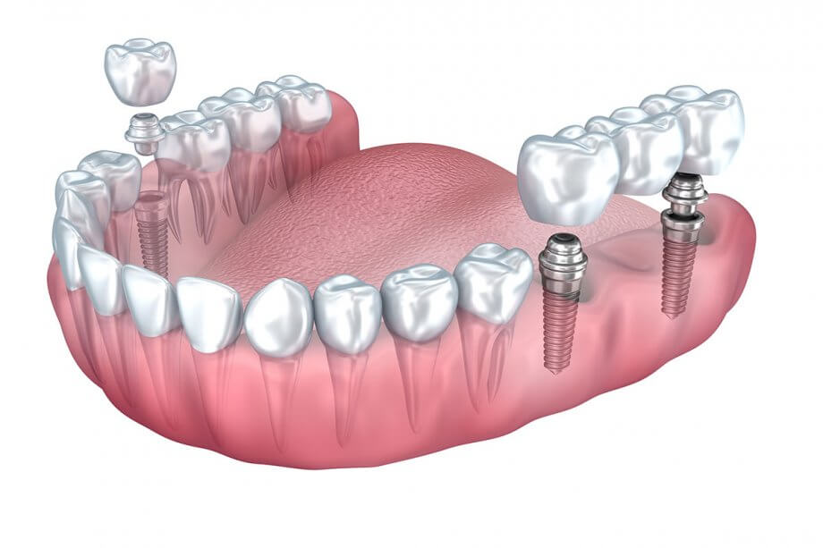 Millised on hambaimplantaatide vastunäidustused?